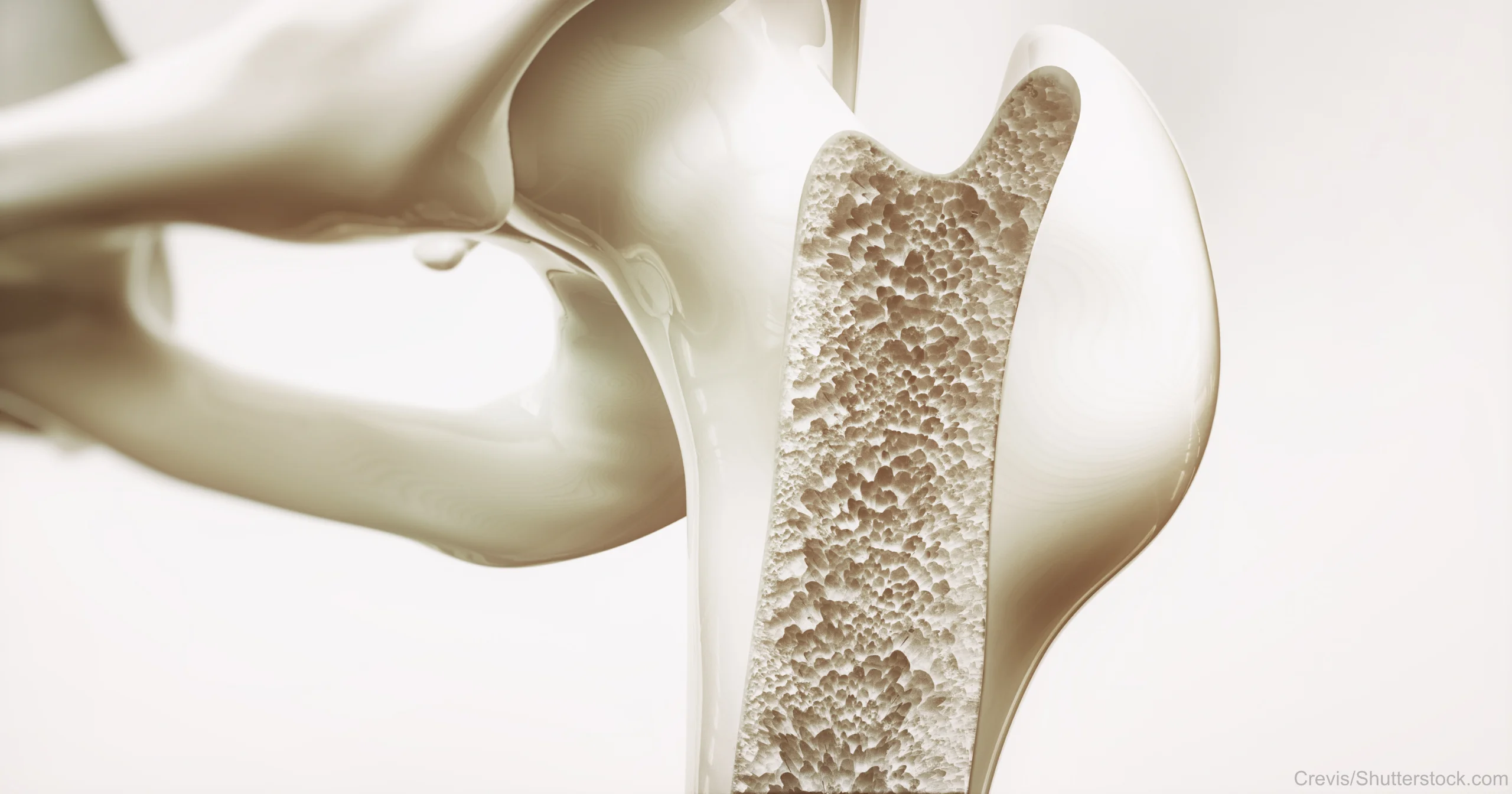 Osteoporose im Knochenquerschnitt – Poröse Knochenstruktur erkennbar. Vitalpilze